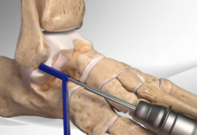 Ankle Surgery