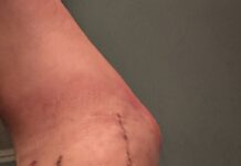 Two Weeks Post Ankle Reconstruction